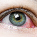 Sol, arena, mar y… ¿conjuntivitis?